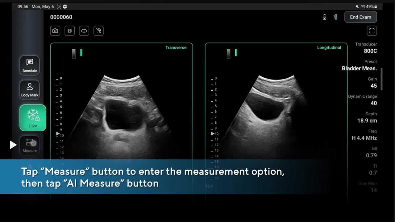 Asus Handheld Ultrasound LU800 | to PVR measurement