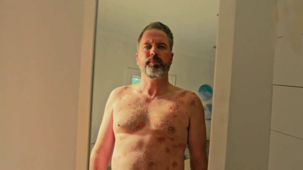 Who sings in the AbbVie psoriasis treatment ad?